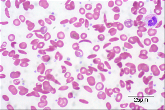 Sickle cell blood smear